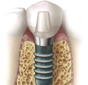 インプラントとは